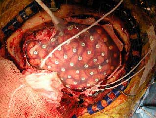 UCSF neurosurgeons place 64-electrode grids on the surface of the brain's temporal and frontal lobes to locate regions where epileptic seizures originate. These grids allowed UC Berkeley neuroscientists to study the interaction of brain waves during simple tasks, such as word recognition or hand movements. (Images courtesy the Knight Lab)