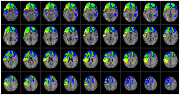 Lesion overlap map illustrating common and distinctive brain regions for Val/Val (blue) and Val/Met (yellow) genotype patients. Overlap between Val/Val and Val/Met genotype patients is illustrated in green. In each axial slice, the right hemisphere is on the reader’s left. Credit Barbey et al./PLOS ONE.