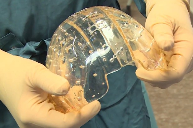 3D printed skull implant Photo Credit: UMC Utrecht