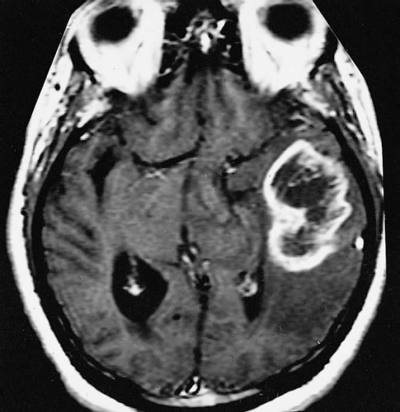 The study revealed that EGFR signaling is suppressed in a subset of glioblastomas. This image is for illustrative purposes only and shows an MRI brain scan of a person with glioblastoma brain cancer. Credit The Armed Forces Institute of Pathology.