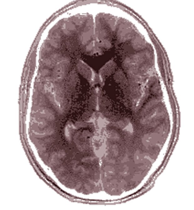 Reviewing MRI data, researchers found the brain anatomy of people with autism above the age of six was mostly indistinguishable from that of typically developing individuals. This image is for illustrative purposes only. Credit McZusatz.