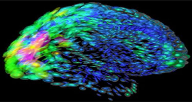 The human brain using colors and shapes to show neurological differences between two people. Credit Arthur Toga, University of California, Los Angeles via NIGMS.