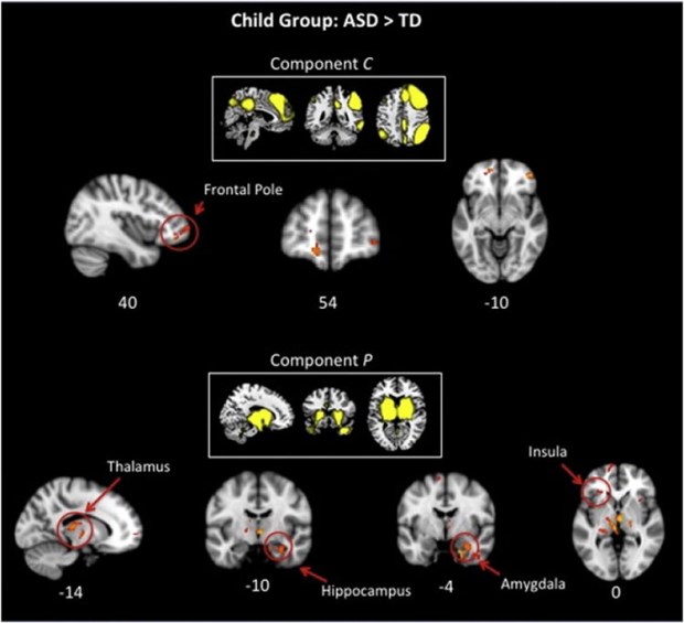 age-brain-related-changes-autism