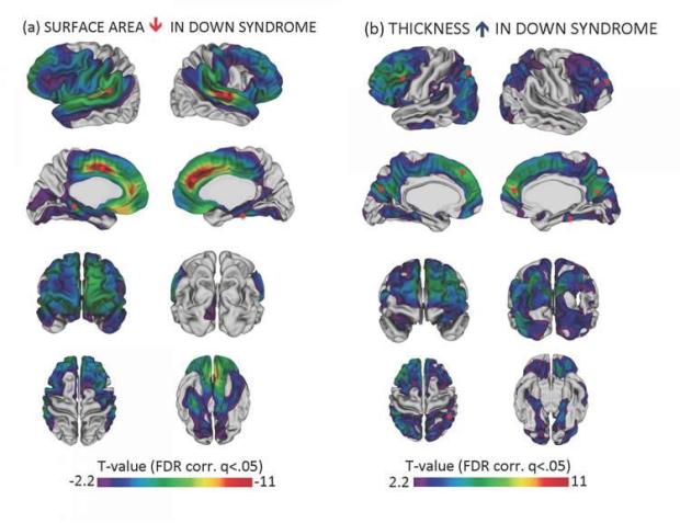 Reductions in cortical surface area and increases in cortical thickness in Down syndrome relative to typical controls. Panel A shows that the cortex surface area is lower in Down syndrome; panel B shows that the cortex is thicker in Down syndrome brains. Small red circles indicate the approximate locations where cortical surface area and thickness were most different between brains of participants with Down syndrome and brains of typically developing participants. Image credit: Lee et al., National Institute of Mental Health