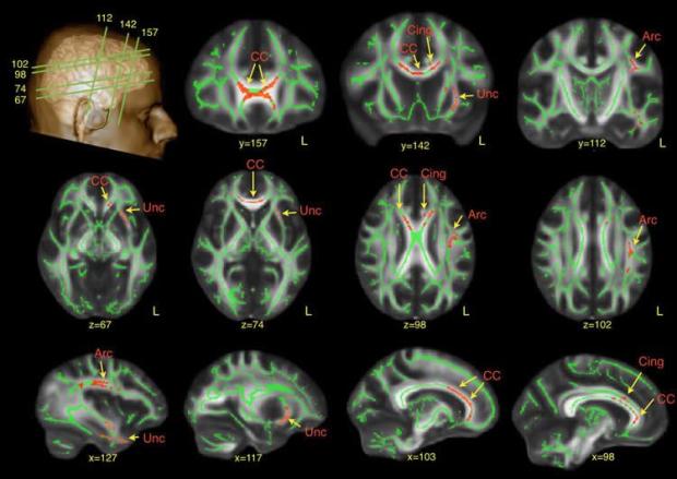 autism-men-neuroimaging
