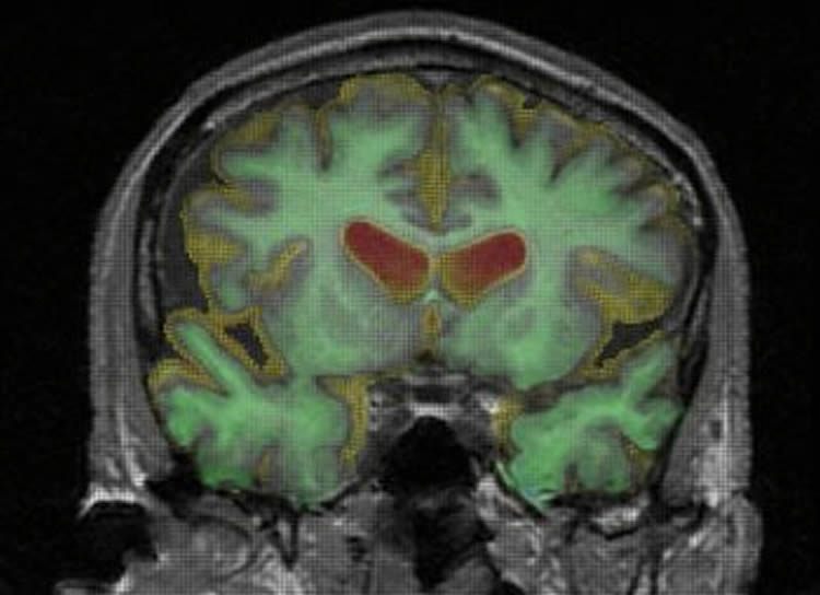 protein-alzheimers-study-neurosciencenews