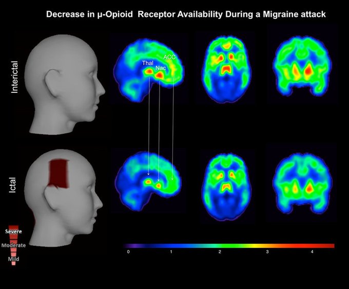 Brain Pain Risactor Pain and Your Brain